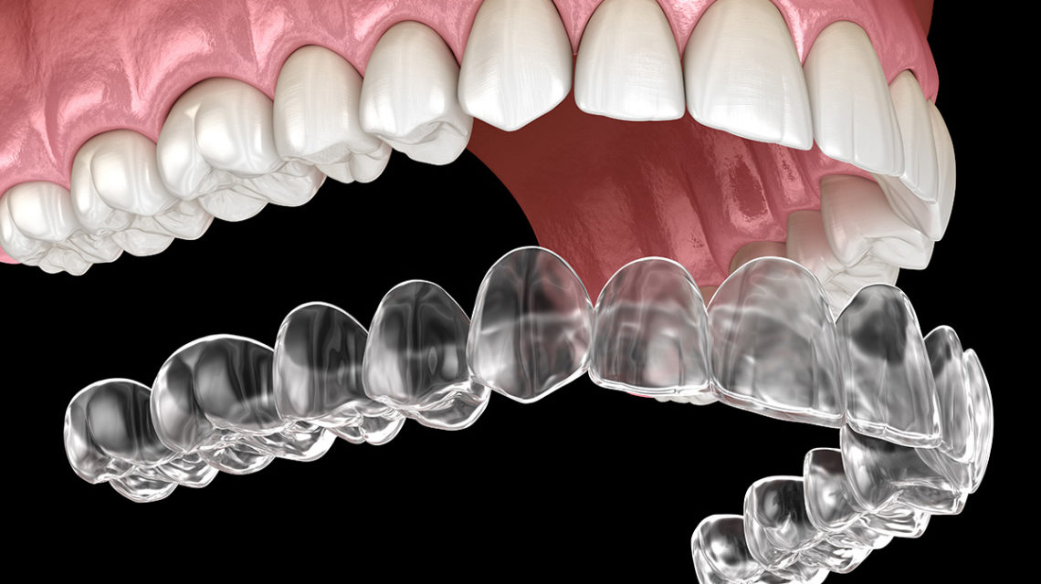 why could invisalign be your right choice