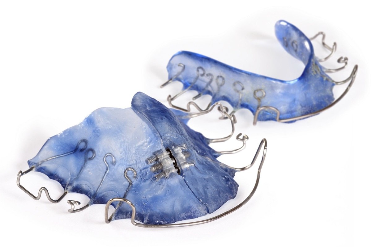 5 sign your retainers needs a replacement