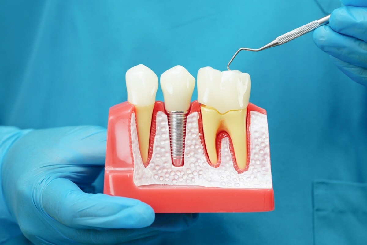 Are Dental Implants Safe?